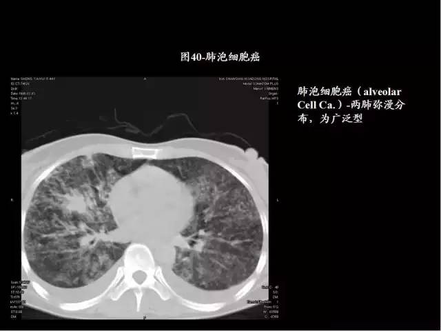 為什么做胸、腹部CT掃描時需要吸氣-屏氣-吐氣？